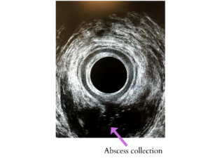 endoanal ultrasound - abscess