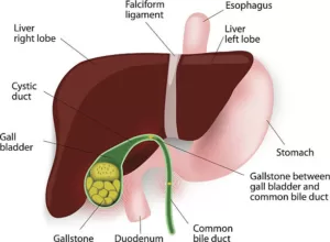 gallstones disease