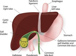 gallstones disease