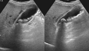 gallstones on ultrasound