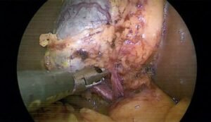 laparoscopic cholecystectomy intra-operative view