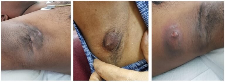 skin lesion; axillary abscess