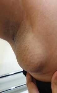 skin lesion; accessory breast tissue at axilla