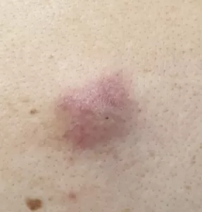 skin lesion; infected cyst