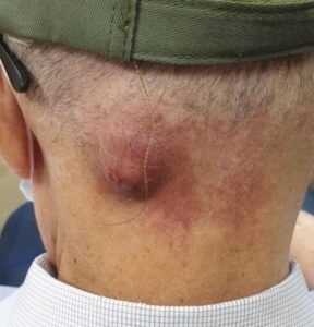 SKin lesion; Infected sebaceous cyst