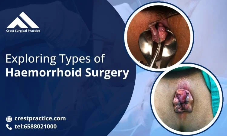 Haemorrhoid Surgery