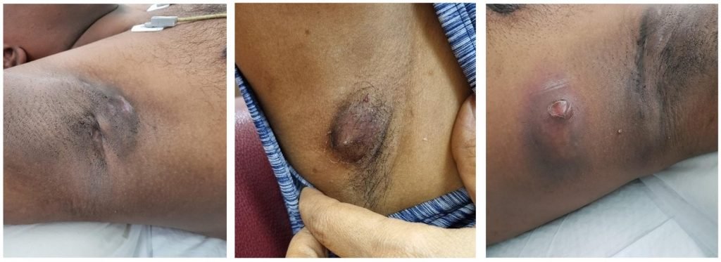 axillary abscess surgery in Singapore