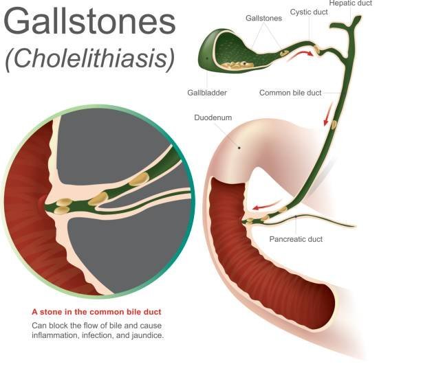 gallstones issue