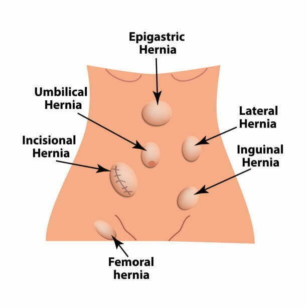 hernia types- Crest Surgical Practice