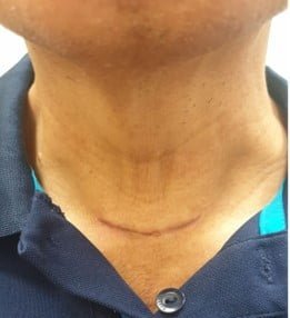 Thyroid cancer surgery in Singapore