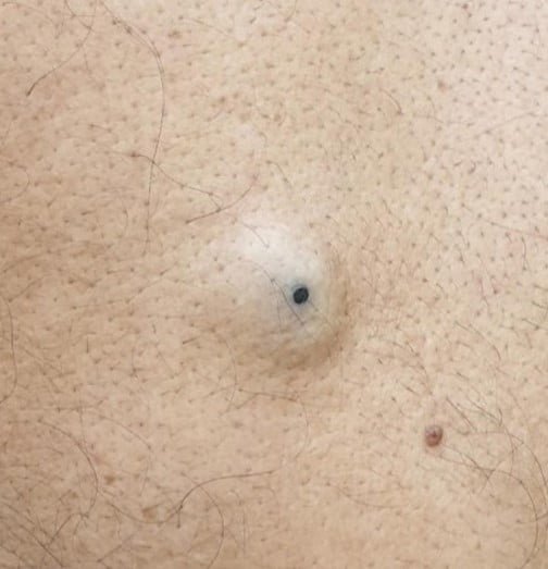 Sebaceous Cyst with a Punctum