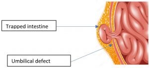 umbilical hernia graphic