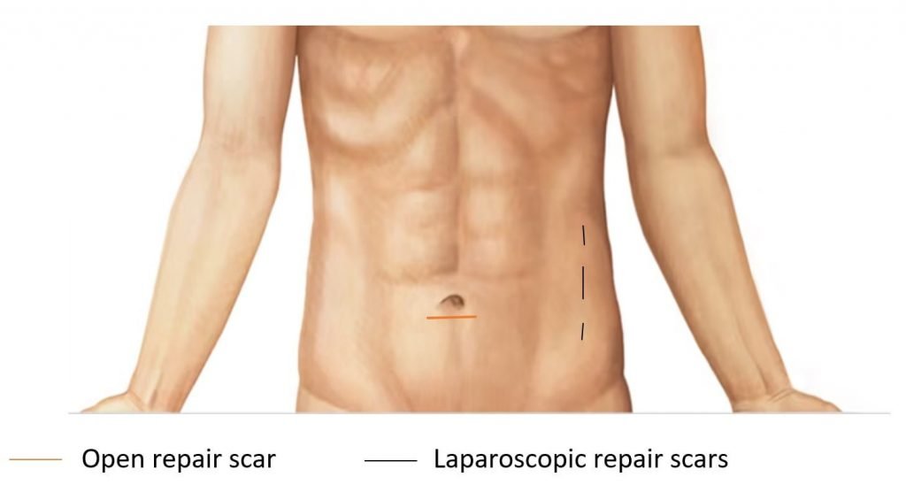 umbilical hernia surgery scar