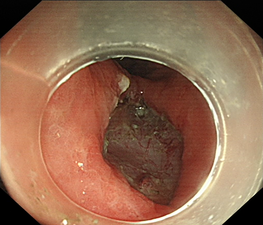 Early stomach cancer after endoscopic submucosal dissection