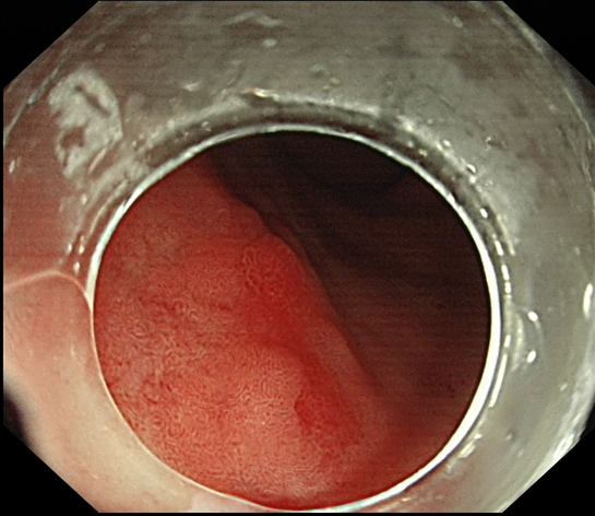 Early stomach cancer on endoscopy