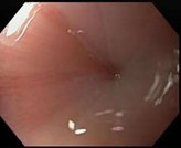 Endoscopic view of the LES of a patient with Achalasia