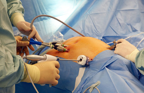 Laparoscopic Surgery