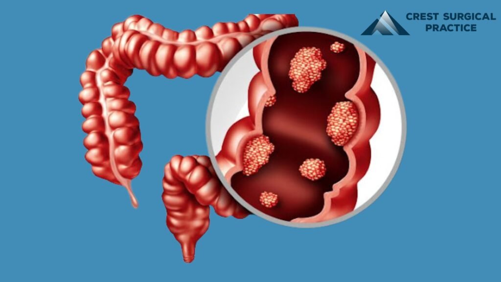 Colon Polyp Removal in Singapore