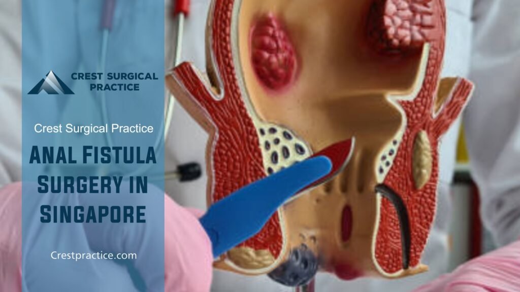 Anal Fistula Surgery
