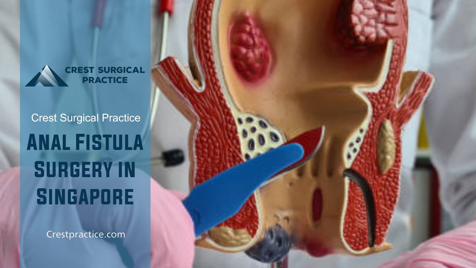 Anal Fistula Surgery