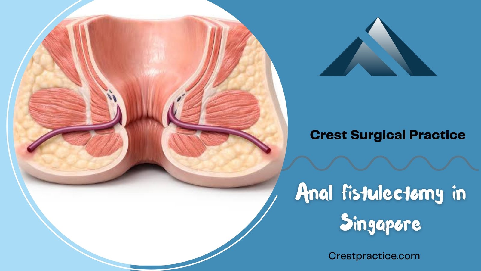 Anal fistulectomy